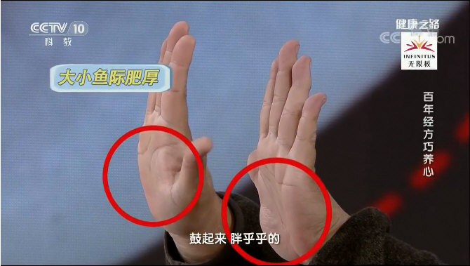 沈氏女科：痰瘀较重的手相：大小鱼际肥厚，鼓起来，胖乎乎的。_1.jpg