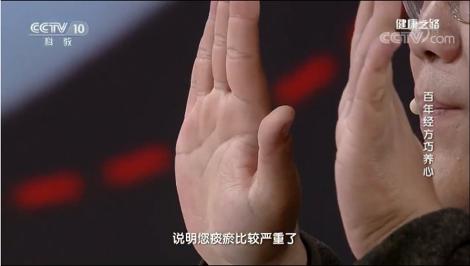 沈氏女科：痰瘀较重的手相：大小鱼际肥厚，鼓起来，胖乎乎的。_2.jpg
