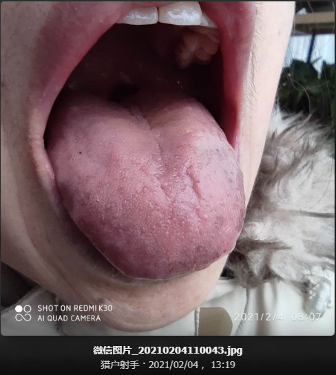 服你开的药2个月之后的舌照(2021年2月4号)舌面侧视：.jpg