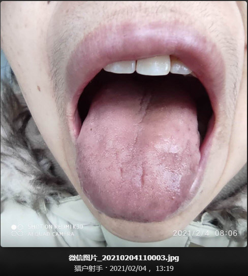 服你开的药2个月之后的舌照(2021年2月4号)舌面正视：.jpg
