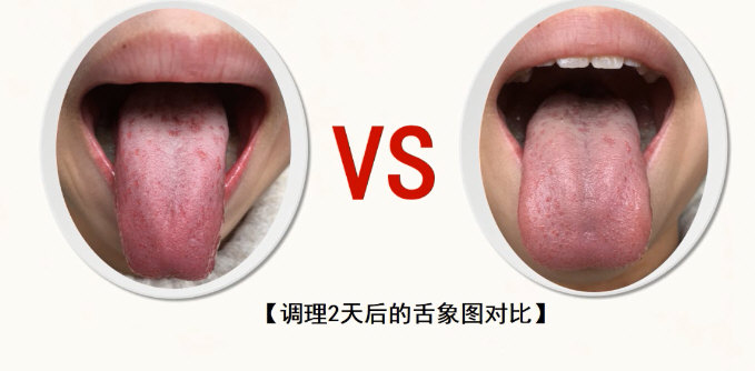 调理2天后与之前的舌象对比：小儿腺样体肥大推拿案例｛肝气郁结型｝.jpg