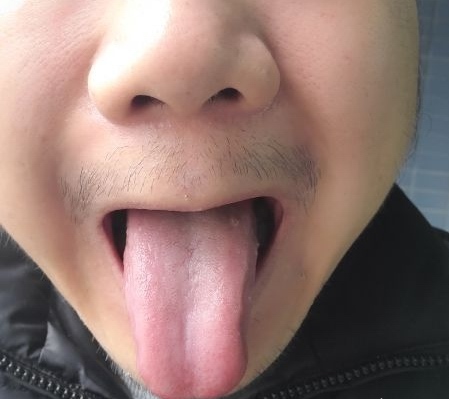 棒棒舌，肌肉紧张度很高，可谓“四逆散舌”.jpg