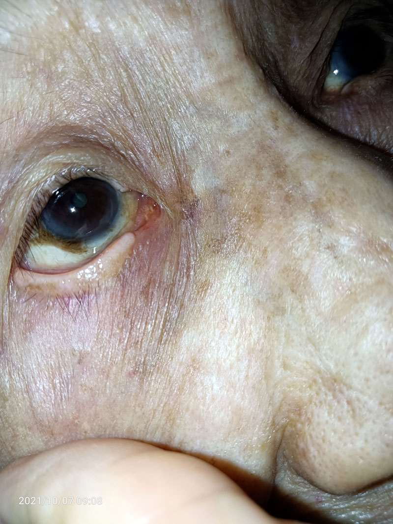 右眼照片(女，97岁)可见｛老年环/白睛黑褐色瘀斑/黑瞳边上的白色絮状物｝.jpg