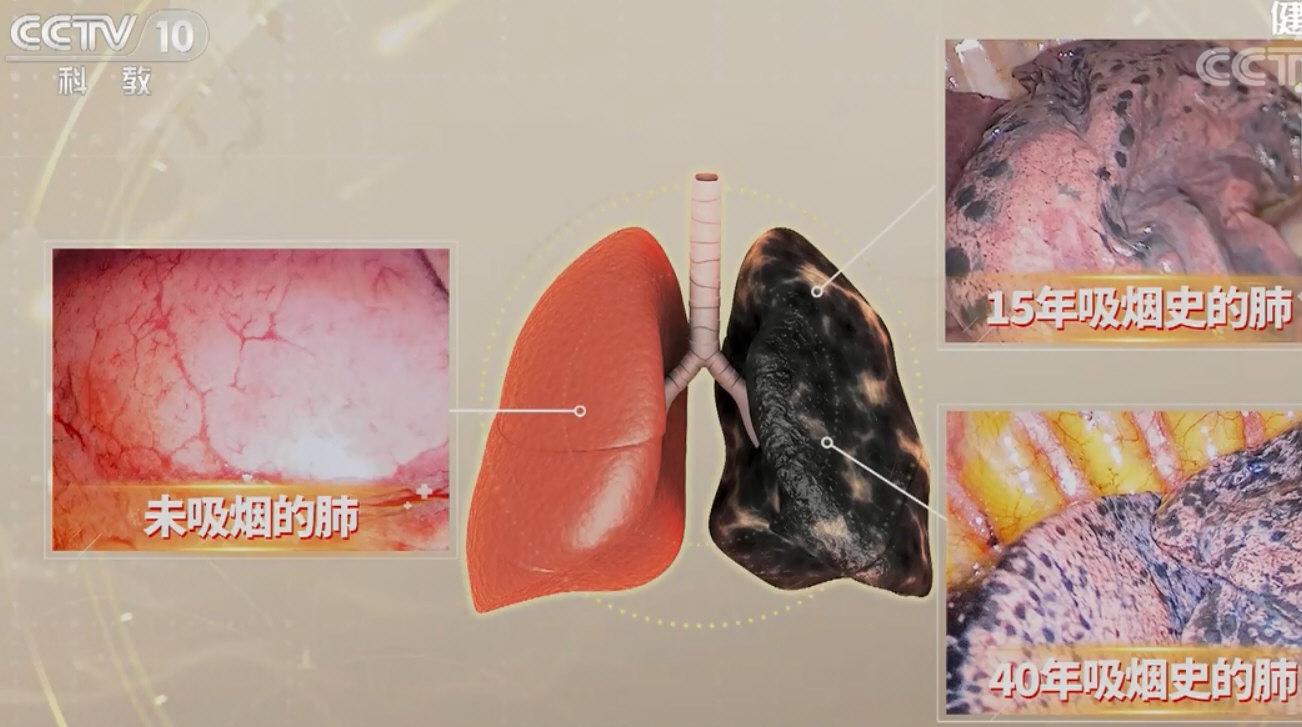 0-40年烟龄者肺部的颜色和形态