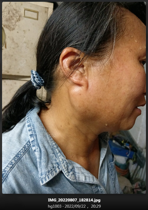 此患者属于｛瘰疬｝还是｛瘿瘤｝，还得仔细斟酌，我觉得更像是｛瘿瘤｝：.jpg