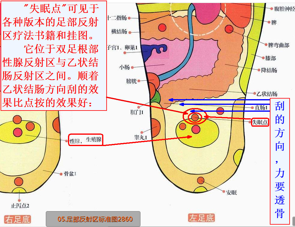足部反射区：失眠点.jpg