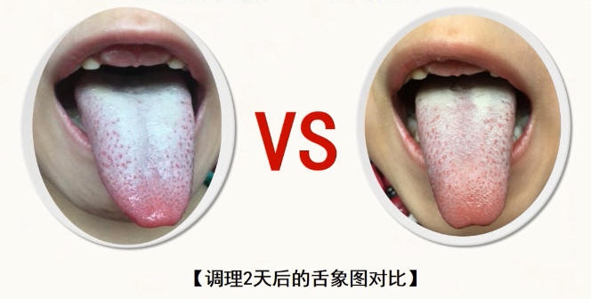 小儿腺样体肥大案例(心肾不交型-上热下寒证)舌象：调理前与调理两天之后的舌象对比。.jpg