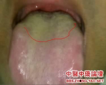 舌苔.jpg