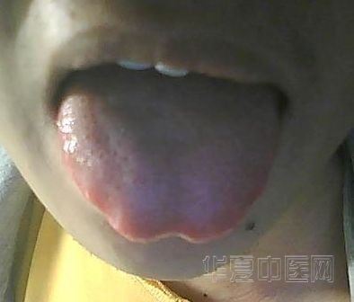 舌象2.jpg