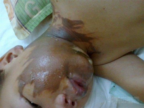 1-2脸上药前.jpg