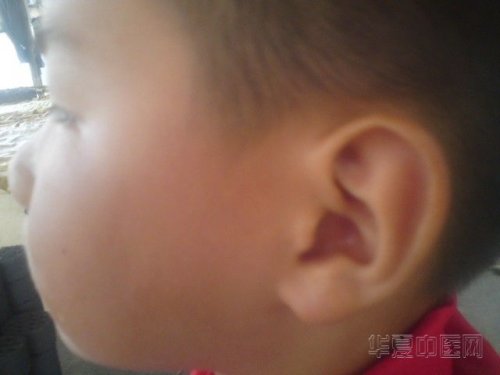 12年五月脸恢复很好.jpg