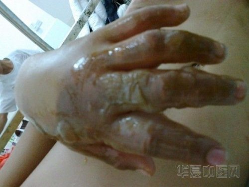手没有上药前.jpg