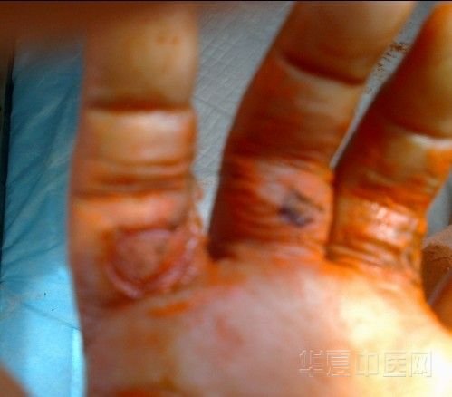 手心上药后.jpg