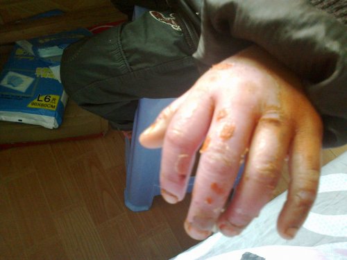 20111030487手背一出院.jpg