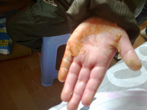 20111030488手心一出院.jpg