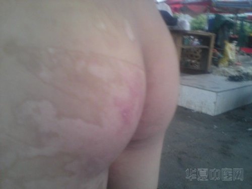 屁股有痕迹但没有疤痕.jpg