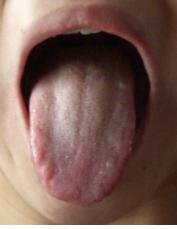 舌苔1（1）.JPG