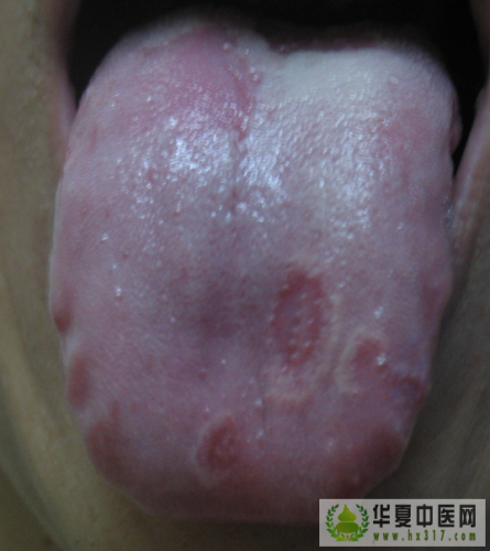 舌苔开始脱落.png
