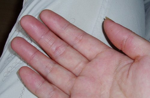 P6160038(大拇指、中指、无名指)右手.jpg