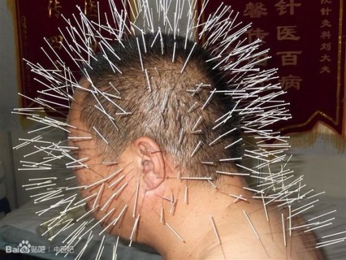 刺猬针灸.jpg