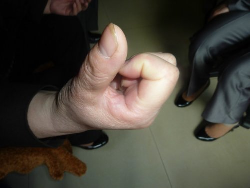 入针即效治类风湿.jpg