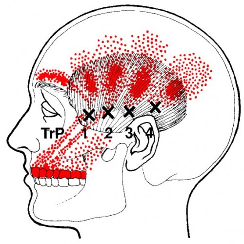 temporalis-trigger-points.jpg
