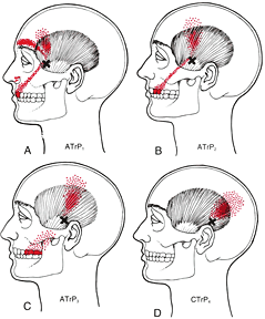 travell_temporalis_trigger_point2_38003_1_1_3703.gif