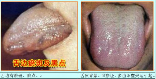 瘀血舌1.jpg
