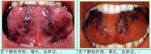 瘀血舌2.jpg