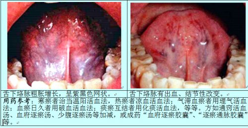 瘀血舌3.jpg