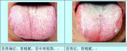 痰湿舌1.jpg