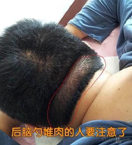 痈（初始症状）.jpg