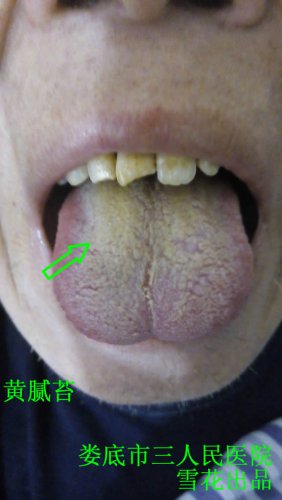 黄腻苔.jpg