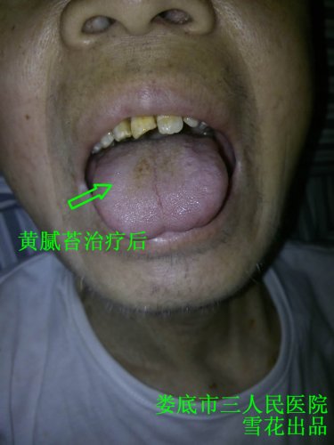 黄腻苔治疗后.jpg