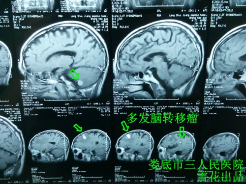 多发脑转移瘤张1.jpg