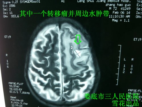 脑转移瘤张2.jpg