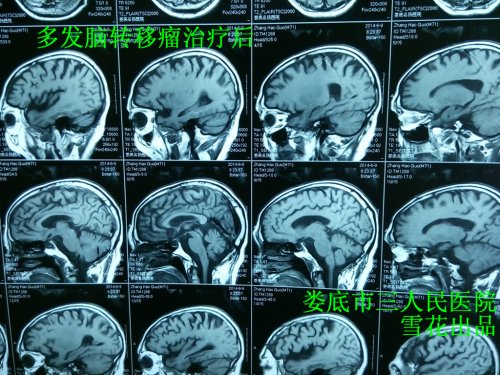 多脑转移瘤治疗后张3.jpg