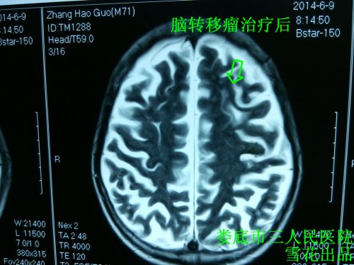 多发脑转移瘤治疗后张4.jpg