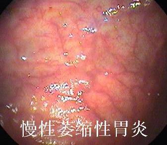 萎缩性胃炎6.jpg