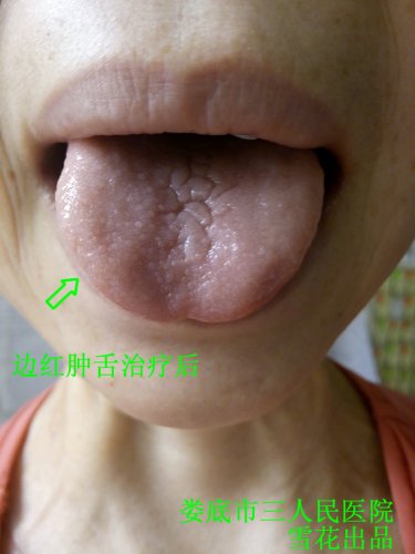 红肿治疗后.jpg