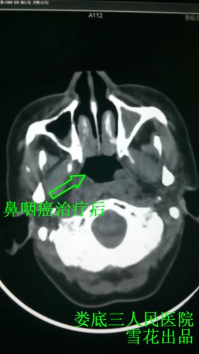 鼻咽癌治疗后.jpg