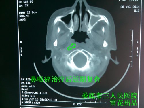 鼻咽复查陈.jpg