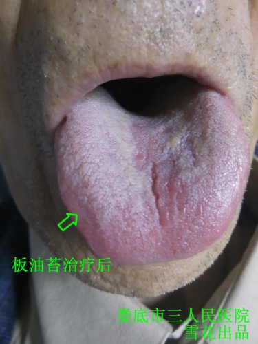 板油治疗后.jpg