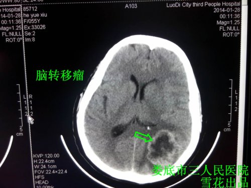 脑瘤何.jpg