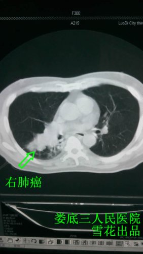 右肺癌辜.jpg