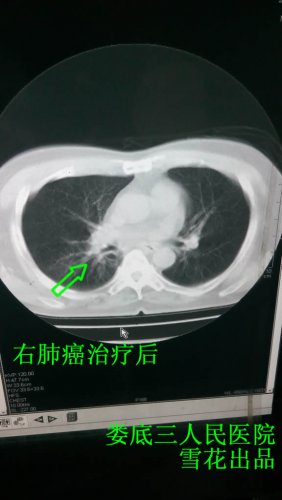 右肺癌治疗后辜.jpg