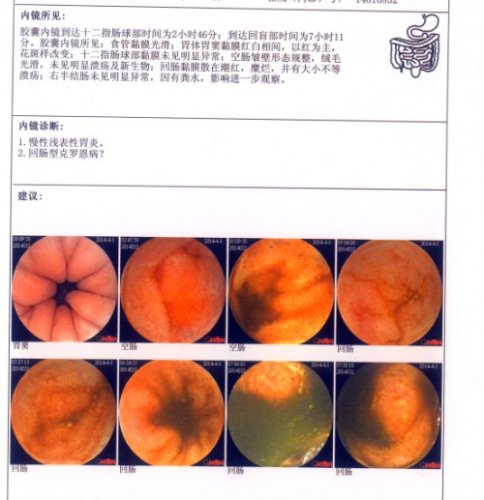 胶囊内镜.jpg