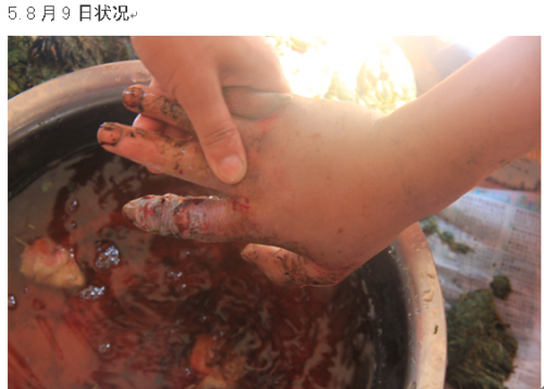 杨海江蛇伤8.9.png
