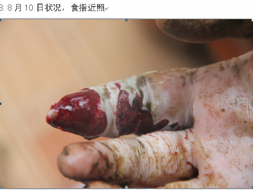 杨海江蛇伤8.10.png