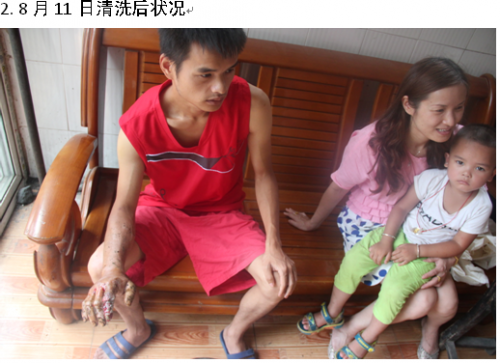 杨海江蛇伤8.11.png